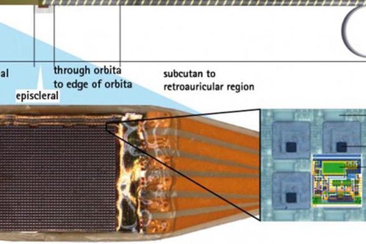 Komponen-komponen chip penangkap gambar yang ditanam di mata