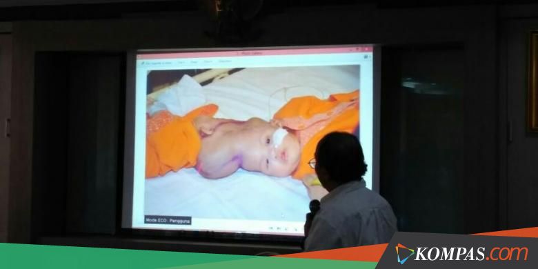 Kembar Siam Dempet Kepala Asal Bekasi Berhasil Dipisahkan