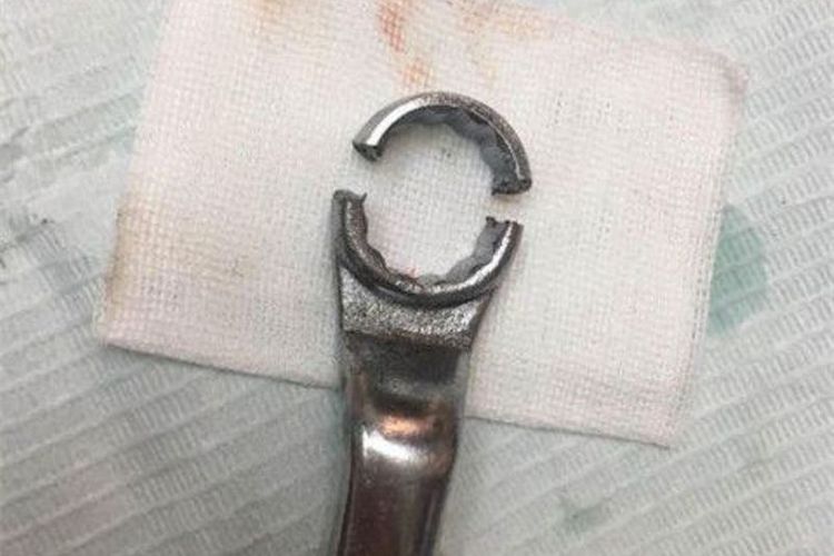 Inilah kunci pas yang menjepit kemaluan seorang pria setelah bisa dipatahkan dengan menggunakan bor dokter gigi.(Shanghaiist)