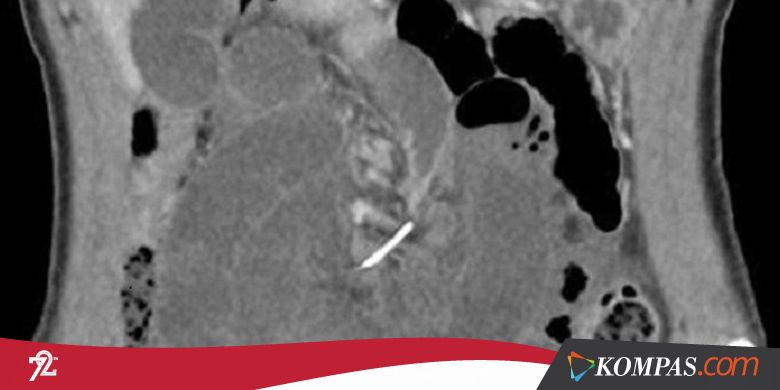 Kawat Gigi Ditemukan di Dalam Usus setelah 10 Tahun