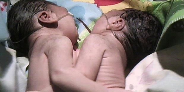Ibu Bayi Kembar Siam Tak Punya Biaya
