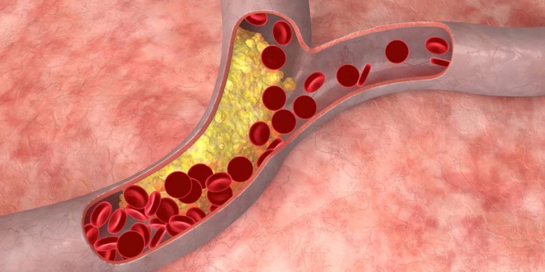 Waspadai, Denegeratif Pengaruhi Pecahnya Pembuluh Darah