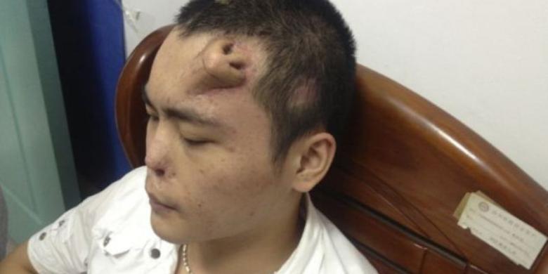 Fenomena, Dokter China "Tumbuhkan" Hidung Baru di Dahi Korban Kecelakaan