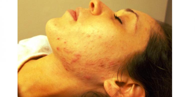 Jerawat Gaby Lassman yang besar menimbulkan iritasi dan radang. (DAILY MAIL)