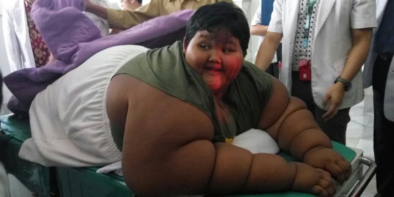 Arya Permana (10) penderita severe obesity ditangani 13 dokter spesialis RSHS.