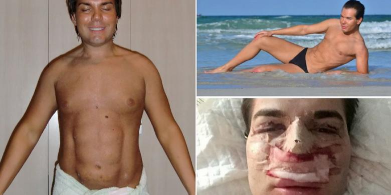 Rodrigo Alves telah mengalami lebih dari 50 prosedur rekonstruksi, termasuk enam paket implan untuk wajah dan rambutnya. Namun, setelah 8 kali operasi hidung, Alvez mulai kesulitan bernapas.