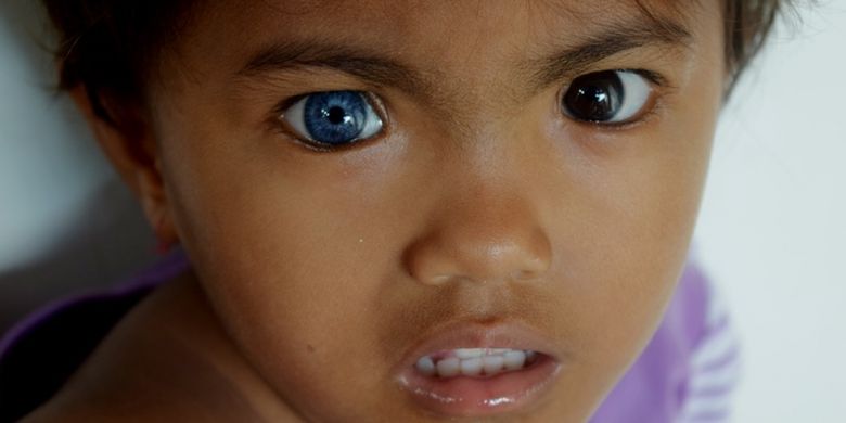 Ditra (3) bocah di Desa Boneatiro, Kecamatan Kapuntori, Kabupaten Buton, Sulawesi Tenggara, memiliki mata yang berbeda. Mata sebelah kanannya berwarna biru dan mata sebelah kirinya berwarna hitam