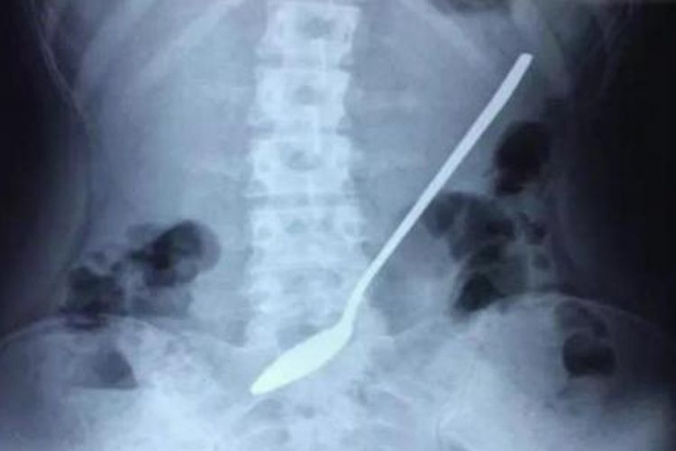 Gambar sendok yang bersarang di dalam perut.